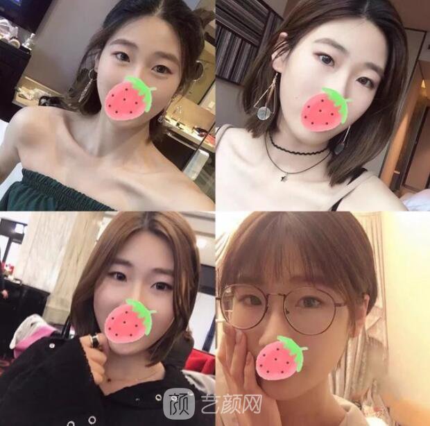 東莞美立方單眼皮割雙眼皮圖|內(nèi)附手術(shù)全程恢復(fù)