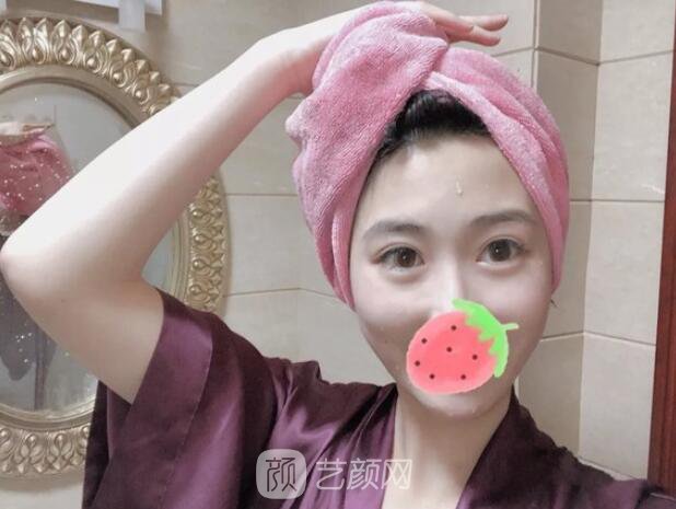 東莞美立方單眼皮割雙眼皮圖|內(nèi)附手術(shù)全程恢復(fù)