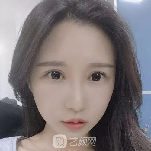 成都銅雀臺(tái)雷剛雙眼皮修復(fù)案例分享，半個(gè)月果圖~