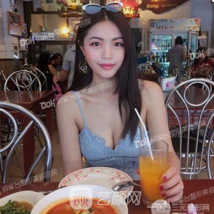 重慶銅雀臺(tái)郭世偉假體隆胸案例恢復(fù)果圖