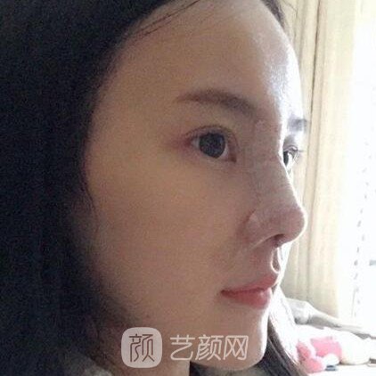 重慶聯(lián)合麗格王巖玻尿酸隆鼻三個(gè)月了，分享果照片~
