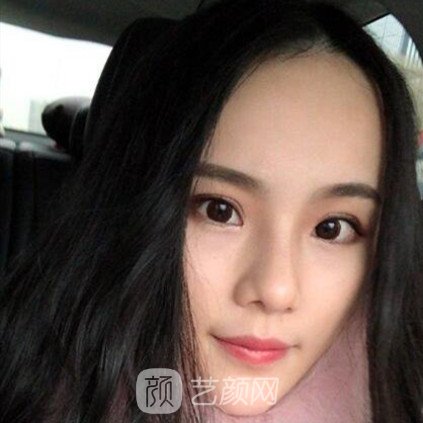 重慶聯(lián)合麗格王巖玻尿酸隆鼻三個(gè)月了，分享果照片~