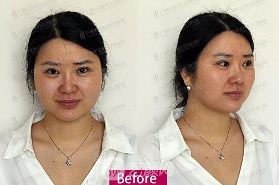 皮-秒激光祛斑案例，恢復(fù)照片分享~