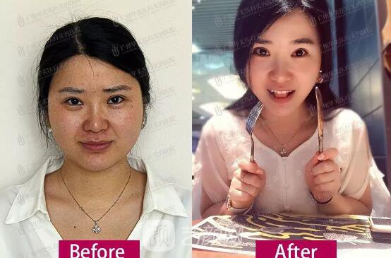 皮-秒激光祛斑案例，恢復(fù)照片分享~