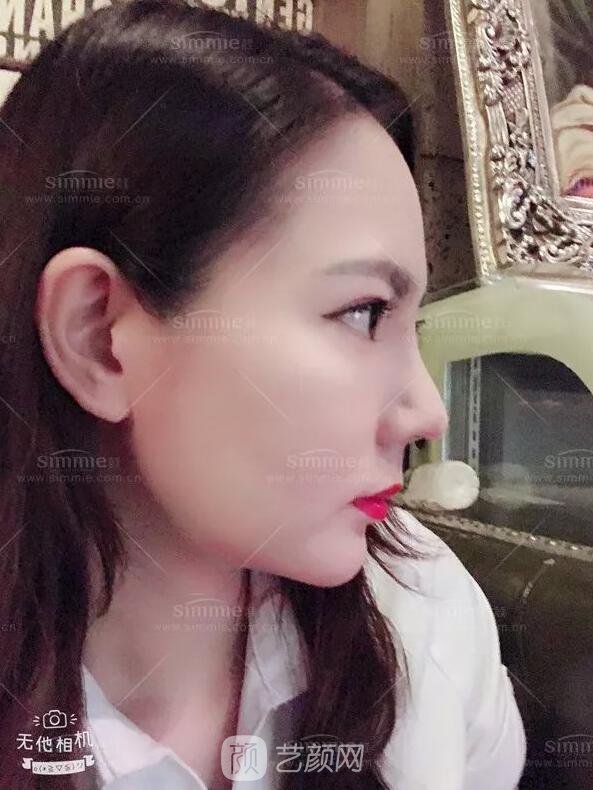 上海喜美全肋鼻修復(fù)+鼻頭縮小+鼻小柱后縮矯正案例~