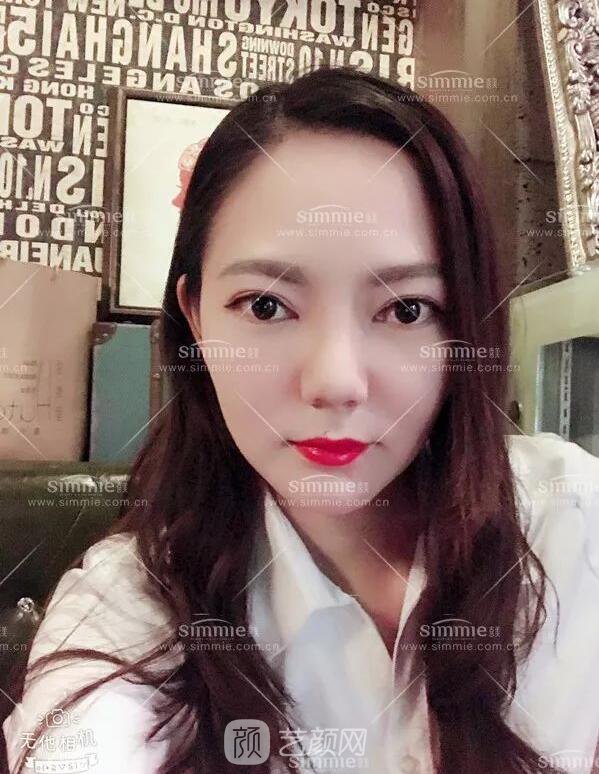 上海喜美全肋鼻修復(fù)+鼻頭縮小+鼻小柱后縮矯正案例~