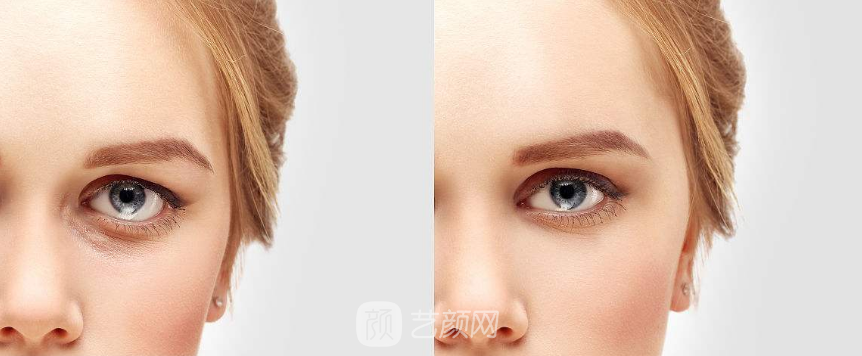 激光祛眼袋價(jià)格貴嗎？大概需要多少錢(qián)？