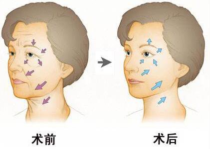 內(nèi)窺鏡除皺
