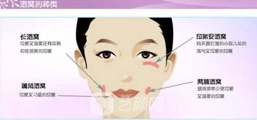 人造酒窩貴嗎？需要多少錢?