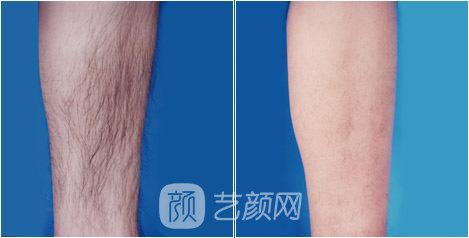 溫州激光脫毛一般要多少錢(qián)？