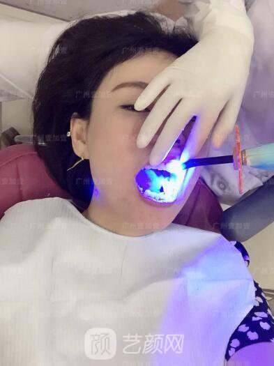 真實(shí)齙牙矯正牙齒案例