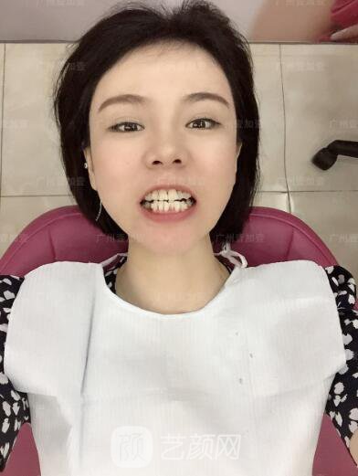 真實(shí)齙牙矯正牙齒案例