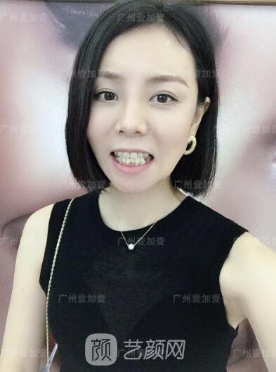 真實(shí)齙牙矯正牙齒案例