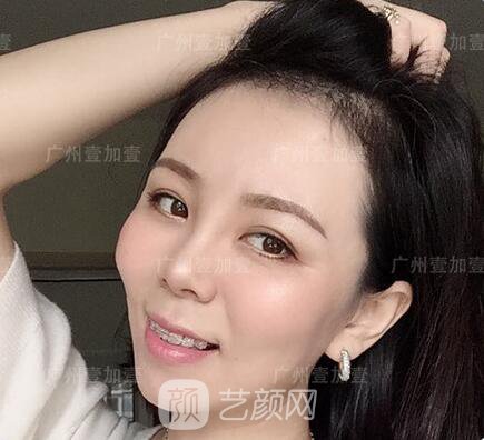 真實(shí)齙牙矯正牙齒案例