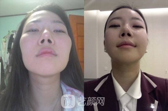 上海顴骨手術(shù)多少錢?