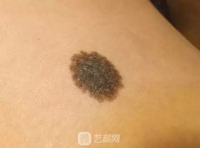 北京激光去痦子多少錢？