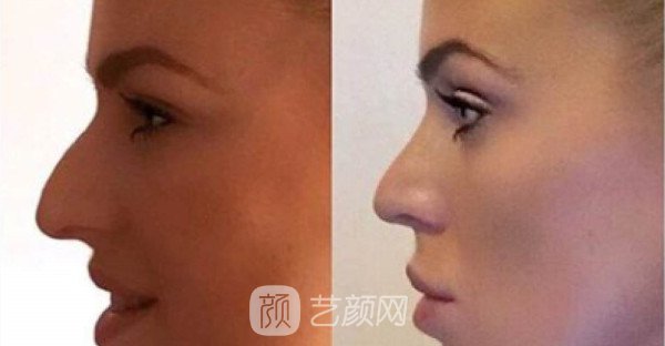 北京自體肋軟骨隆鼻費(fèi)用是多少