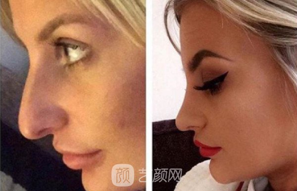 北京自體肋軟骨隆鼻費(fèi)用是多少