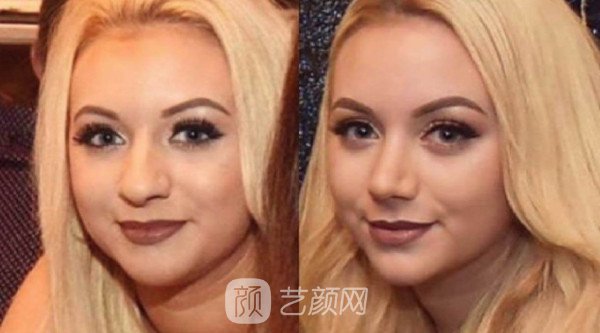 北京自體肋軟骨隆鼻費(fèi)用是多少