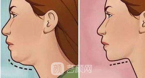 深圳磨尖下巴骨多少錢?