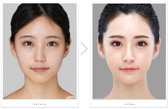 天津下頜角磨削一般多少錢?