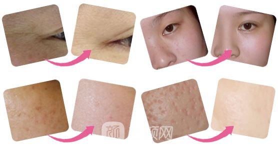 唐山做全身光子嫩膚價(jià)格大概多少錢？