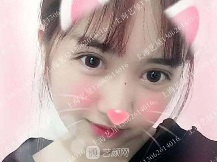 上海藝星割雙眼皮術(shù)后一個月恢復(fù)日記一則~