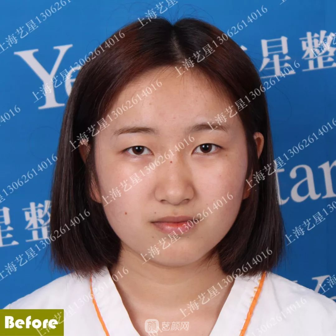 上海藝星割雙眼皮術(shù)后一個月恢復(fù)日記一則~