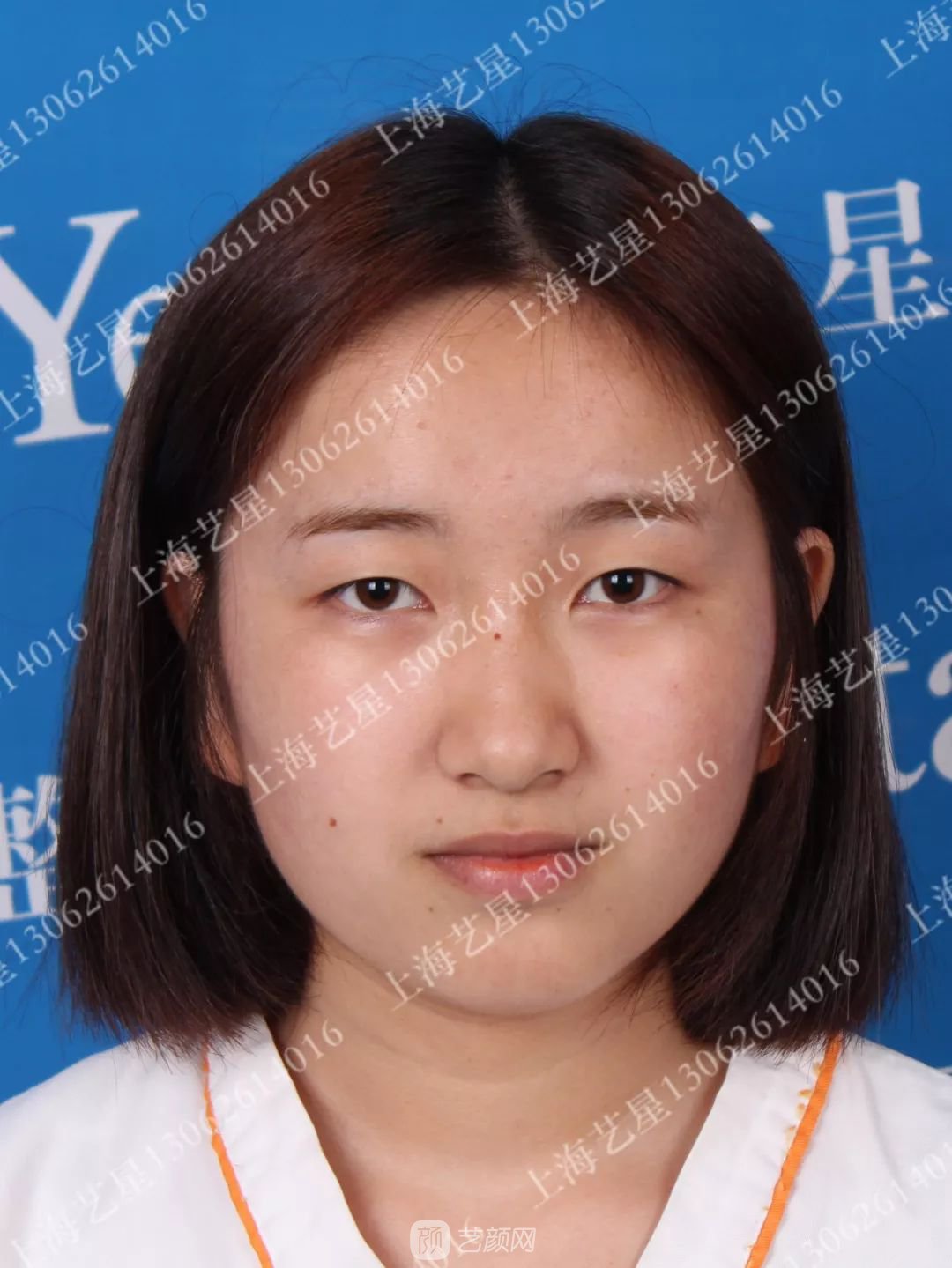 上海藝星割雙眼皮術(shù)后一個月恢復(fù)日記一則~