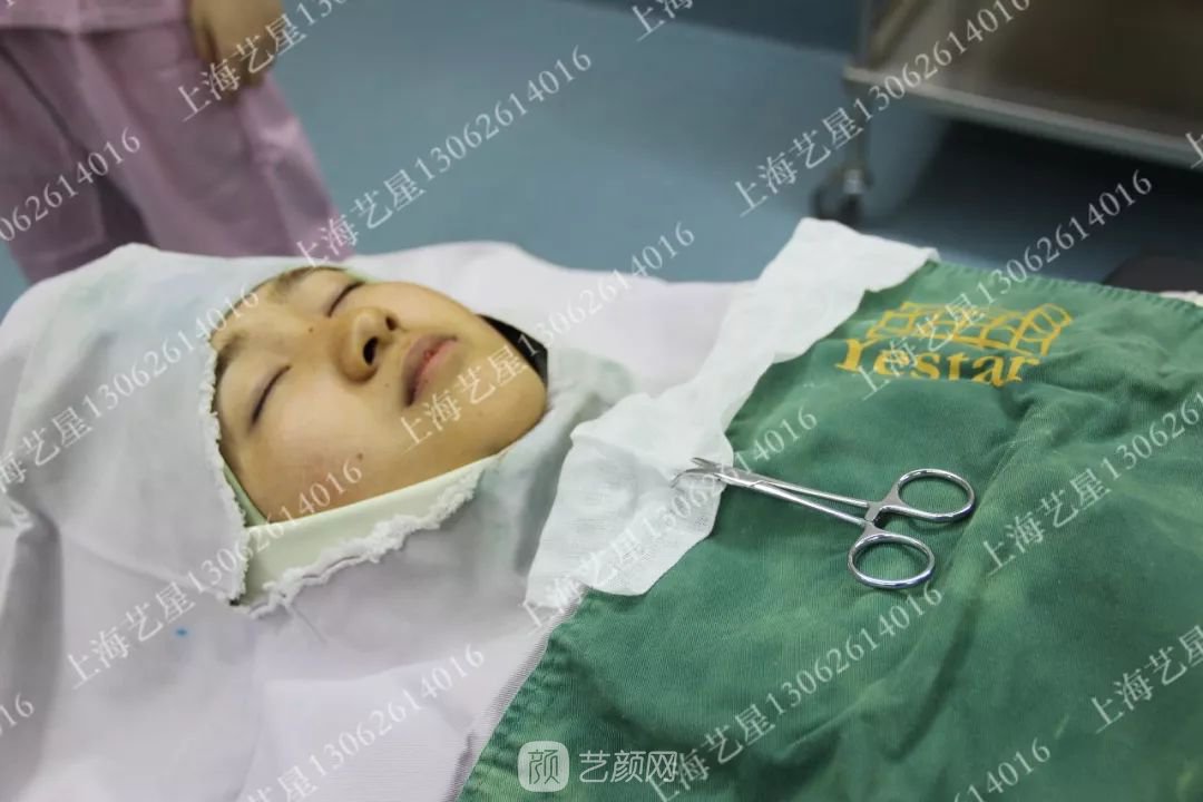 上海藝星割雙眼皮術(shù)后一個月恢復(fù)日記一則~