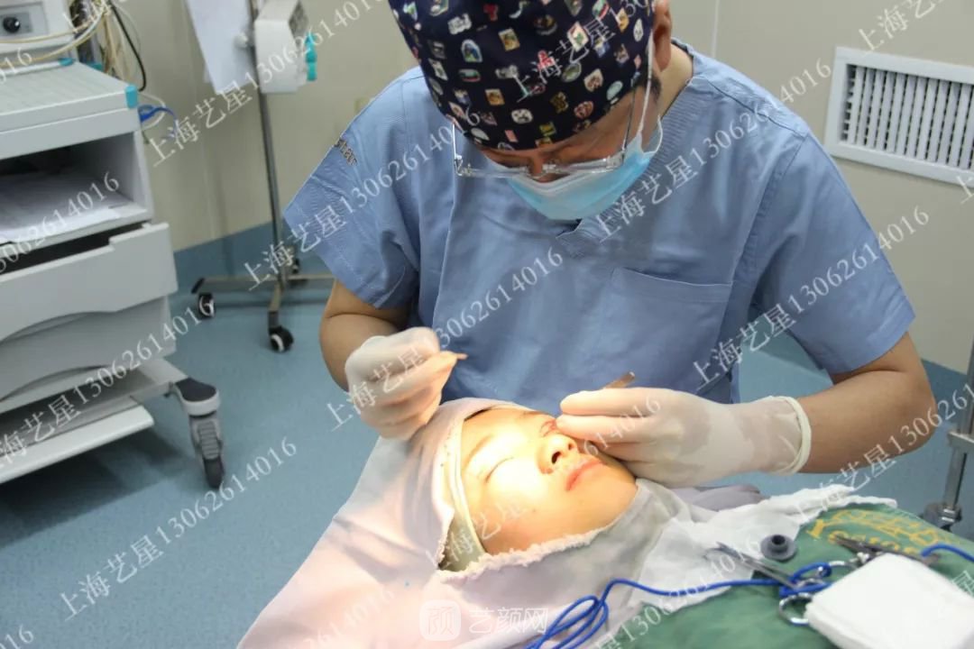 上海藝星割雙眼皮術(shù)后一個月恢復(fù)日記一則~