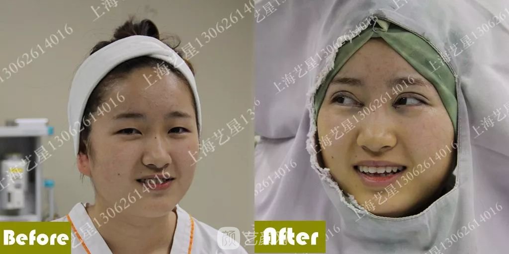 上海藝星割雙眼皮術(shù)后一個月恢復(fù)日記一則~