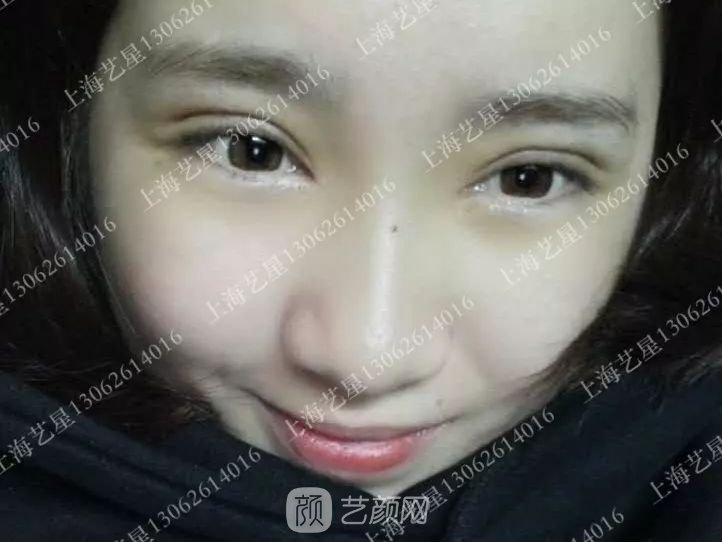 上海藝星割雙眼皮術(shù)后一個月恢復(fù)日記一則~