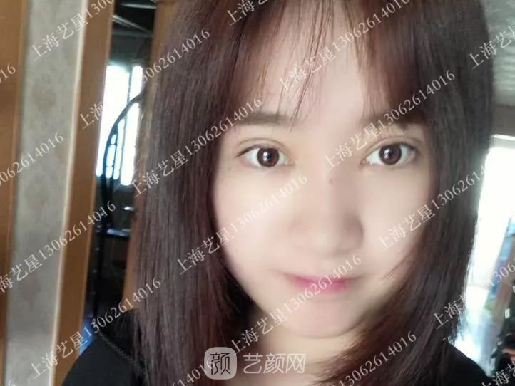 上海藝星割雙眼皮術(shù)后一個月恢復(fù)日記一則~