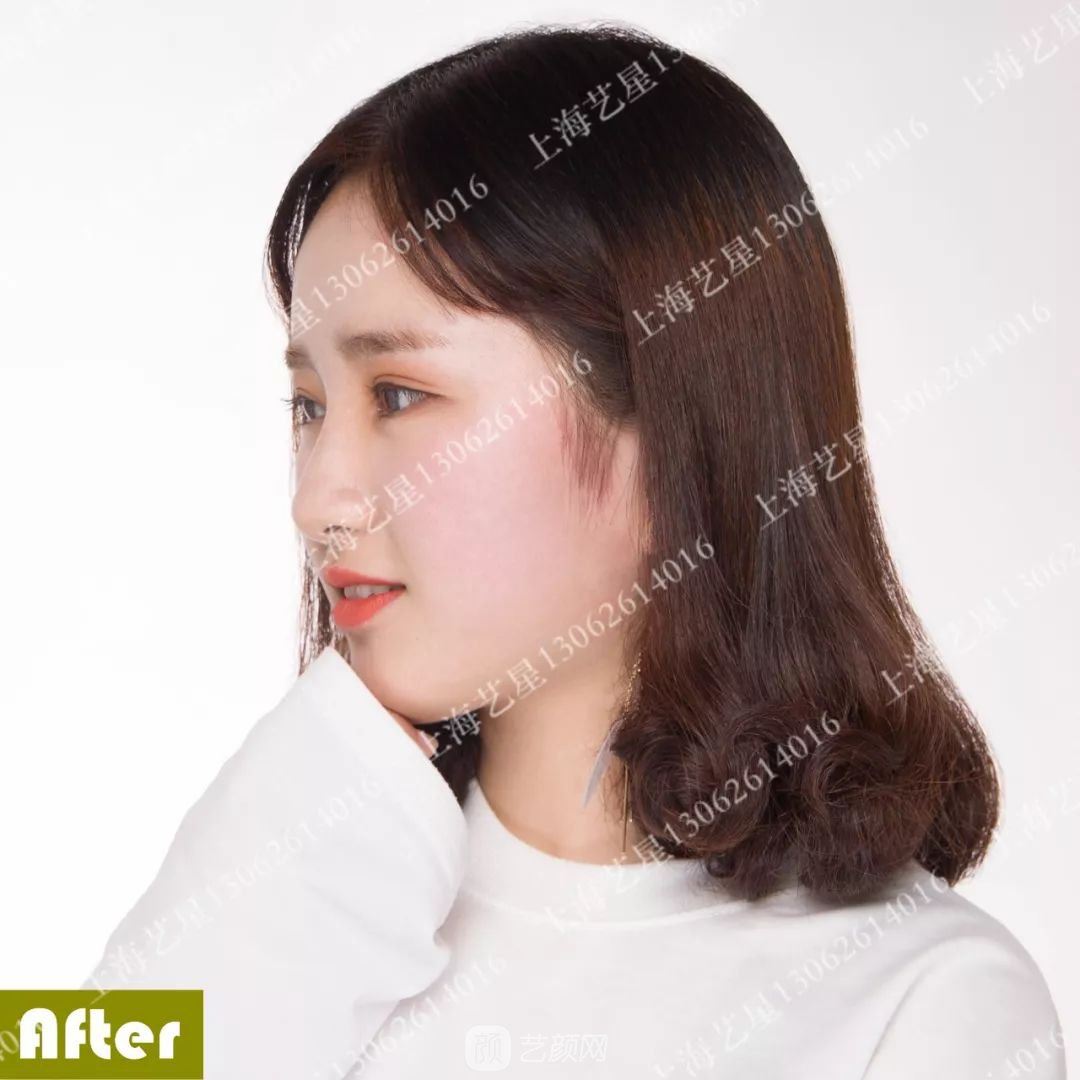 上海藝星割雙眼皮術(shù)后一個月恢復(fù)日記一則~