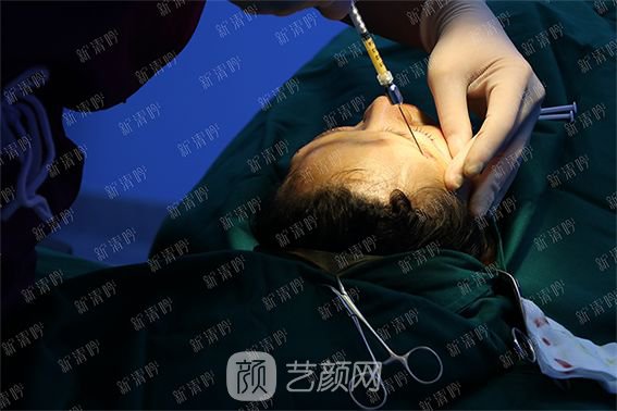 杭州新清吟陳永自體脂肪面部填充+注射瘦臉除皺案例直播~