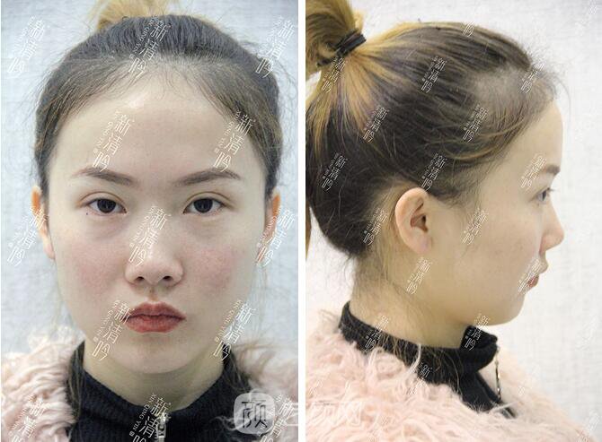 耳軟骨隆鼻果圖分享，術(shù)后~