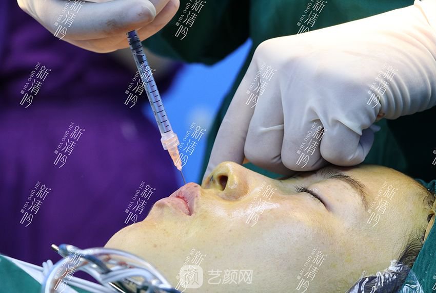 耳軟骨隆鼻果圖分享，術(shù)后~