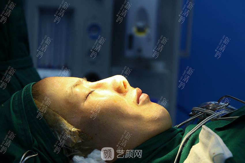 耳軟骨隆鼻果圖分享，術(shù)后~