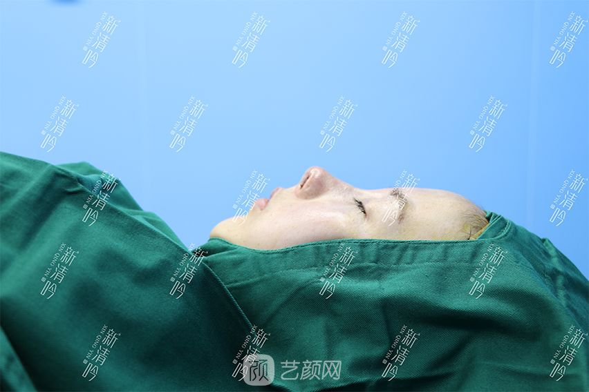 耳軟骨隆鼻果圖分享，術(shù)后~