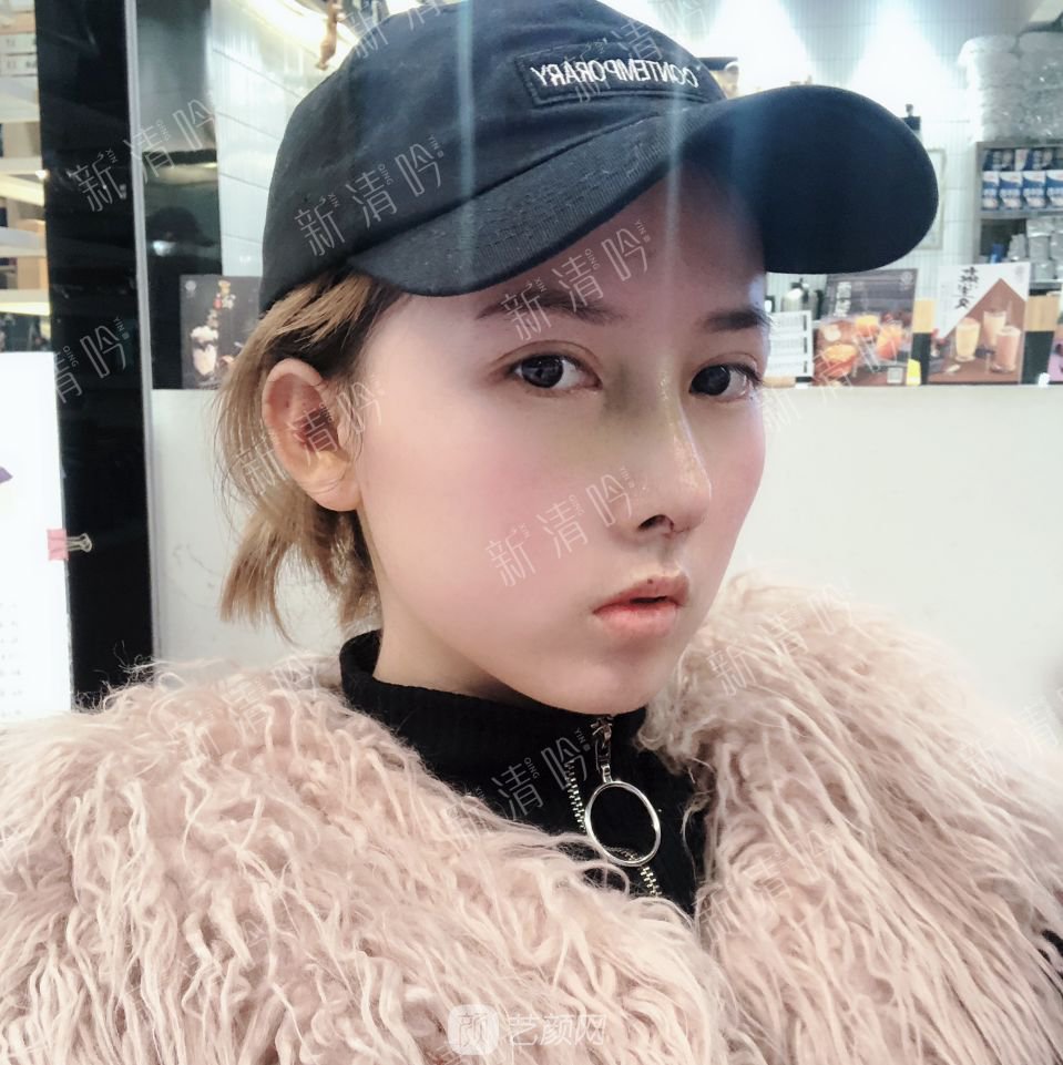 耳軟骨綜合隆鼻半個月了，分享恢復(fù)果照片~