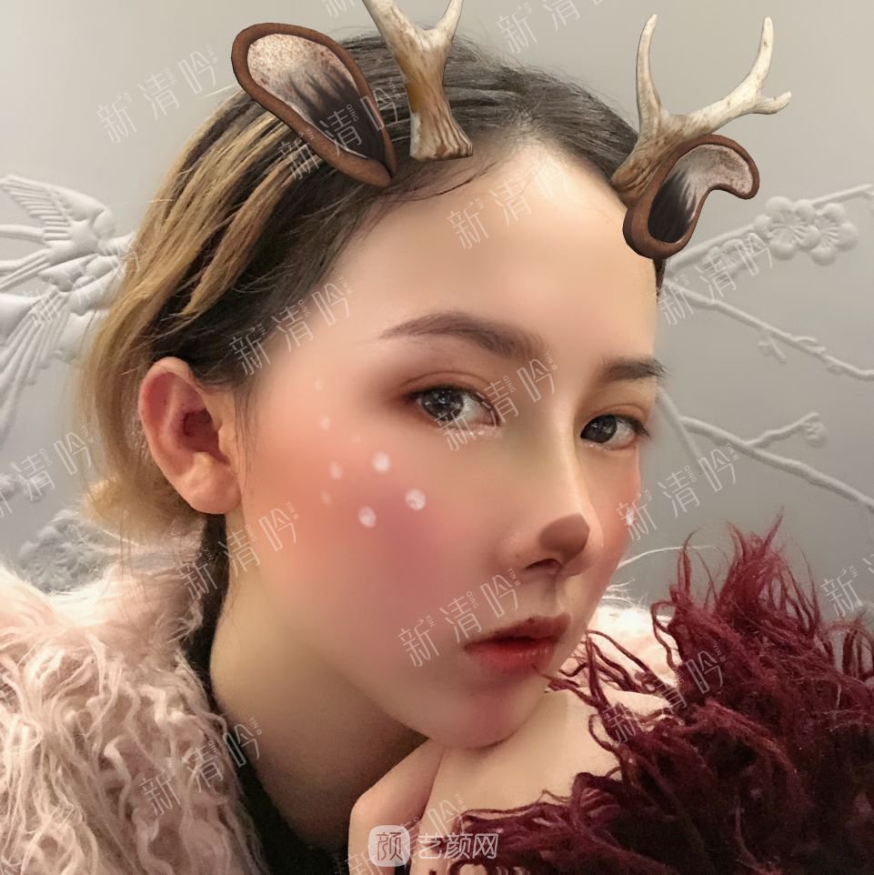 耳軟骨綜合隆鼻半個月了，分享恢復(fù)果照片~