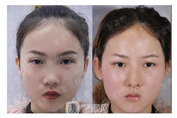 耳軟骨綜合隆鼻半個月了，分享恢復(fù)果照片~