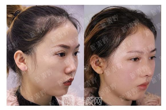 耳軟骨綜合隆鼻半個月了，分享恢復(fù)果照片~