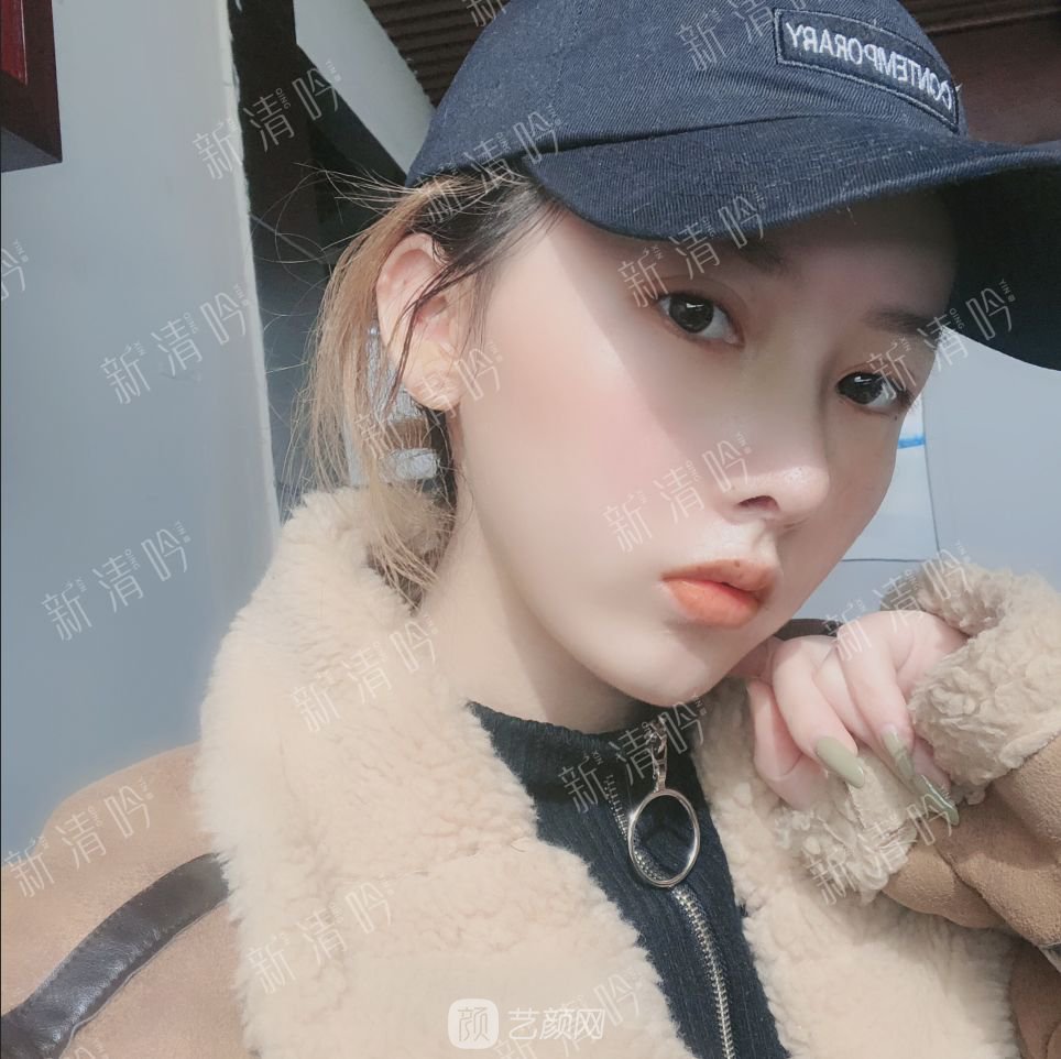 耳軟骨綜合隆鼻半個月了，分享恢復(fù)果照片~