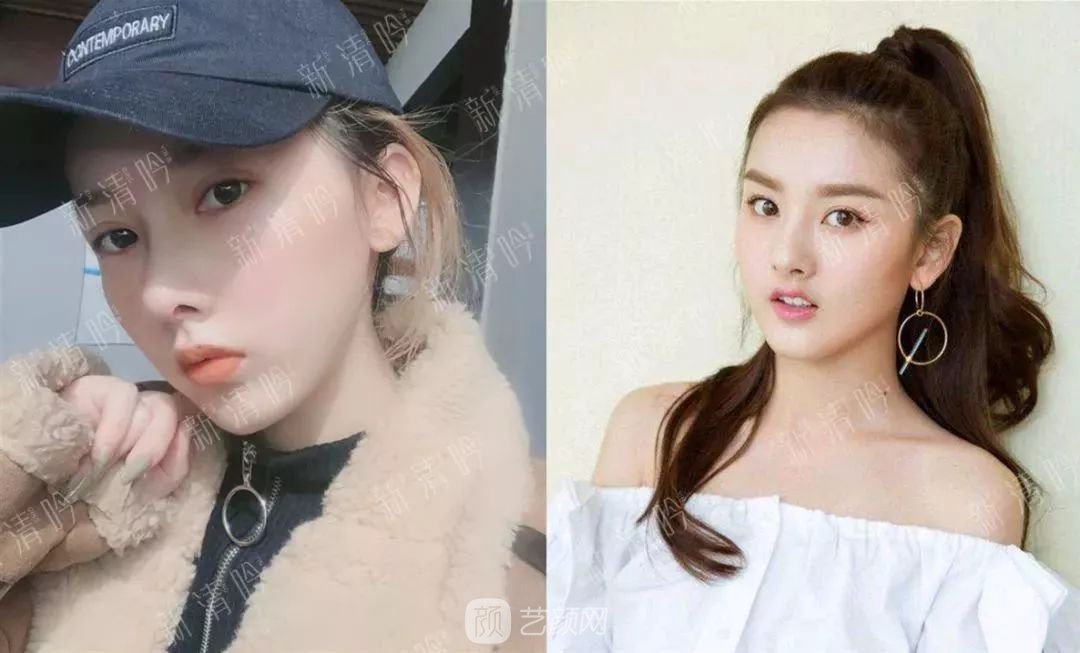 耳軟骨隆鼻果怎么樣？案例照片一覽~