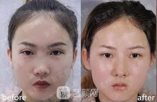 耳軟骨隆鼻果怎么樣？案例照片一覽~