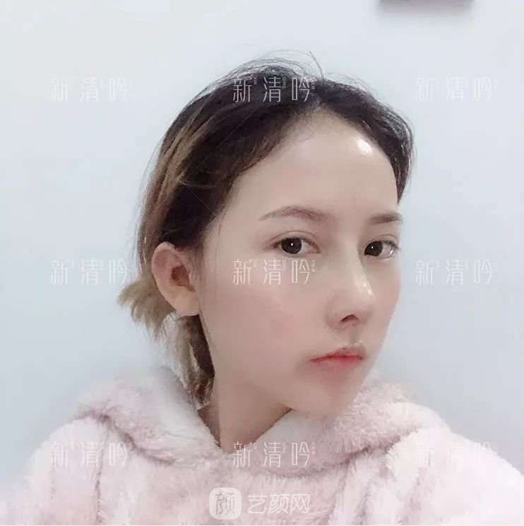 耳軟骨隆鼻果怎么樣？案例照片一覽~