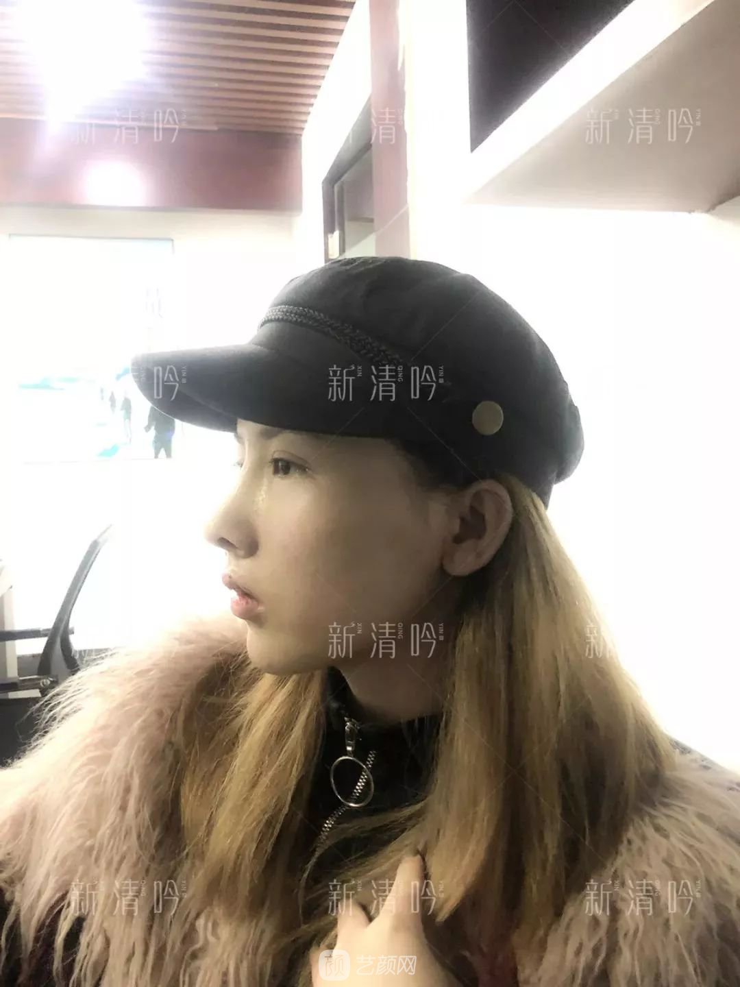 耳軟骨隆鼻果怎么樣？案例照片一覽~