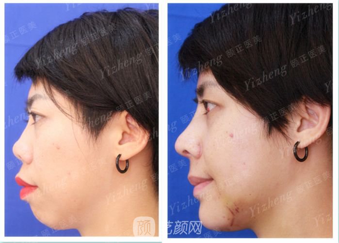 自體肋軟骨隆鼻+假體隆下頜一個月果照片分享~